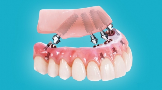 Уникальный метод протезирования зубов all on 4
